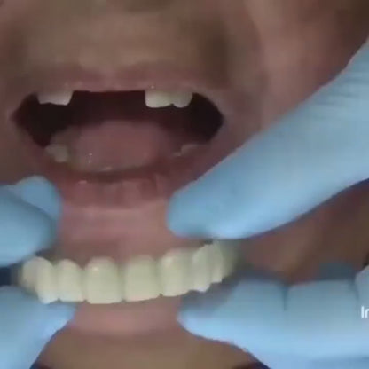 Snap On Smile